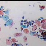 Κοιλοκυττάρωση